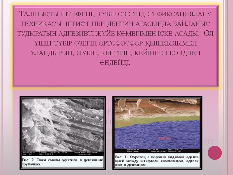 Талшықты штифттің түбір өзегіндегі фиксациялану  техникасы  штифт пен дентин арасында байланыс тудыратын